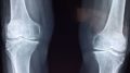 Nieleczona osteoporoza RTG obraz