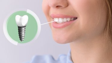 Czym są implanty zębowe
